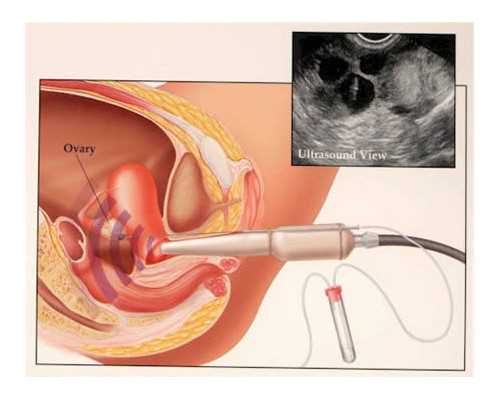 福州供卵试管,福州试管有什么风险(福州第三代试管婴儿)